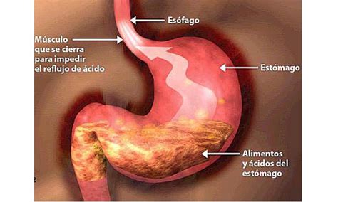 Acidez estomacal padecimiento común que debe ser atendido El