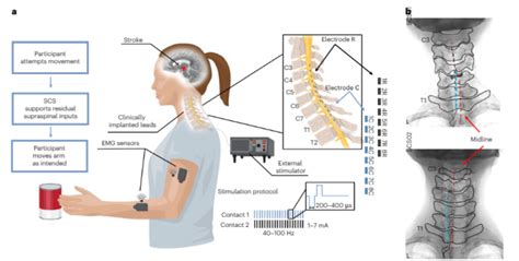 Spinal Cord Stimulation For Stroke Rehabilitation Delsys Europe