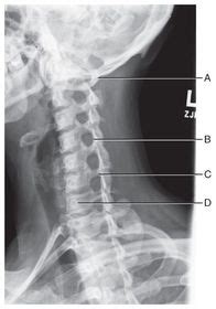 Cervical And Thoracic Spine Procedures Flashcards