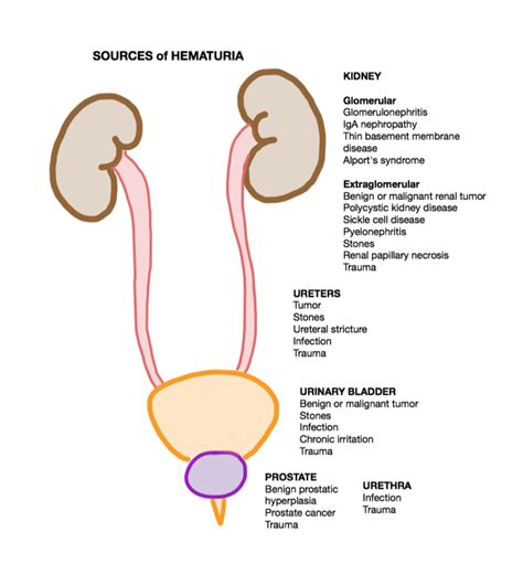 Sourcesofhematuriabyanatomiclocation Dr Thind