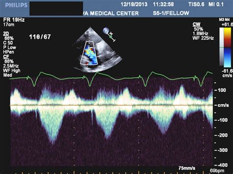 Severe Tricuspid Regurgitation With Giant C V Waves After Pacer