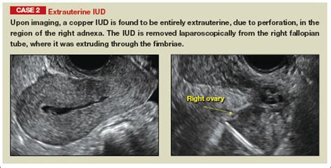 How To Identify And Localize Iuds On Ultrasound Mdedge Obgyn