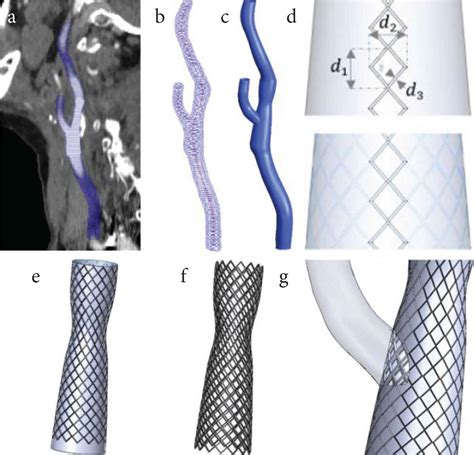 A Computational Study Of The Effect Of Stent Design On Local