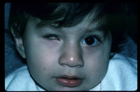 Congenital Anophthalmia & Micropthalmia | Esthetic Eyes