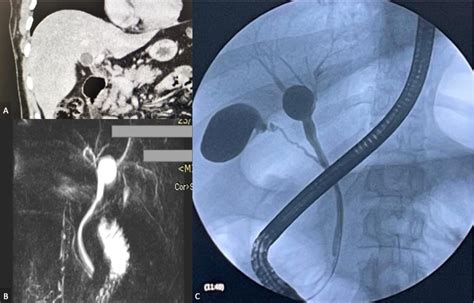 Figure 2 From The Curious Case Of The Choledochal Cyst—revisiting The Todani Classification