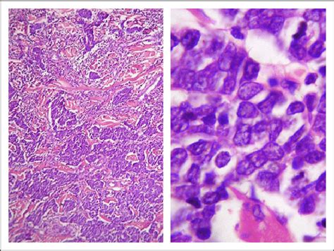 Merkel Cell Carcinoma Prognosis / Merkel Cell Carcinoma, Skin ...