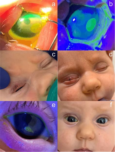 Serial Photography Of An Infant With Congenital Entropion And Corneal