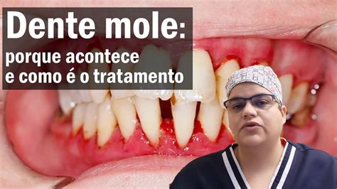 Dente Mole Porque Acontece E Qual O Tratamento Dra Bianca Rosa