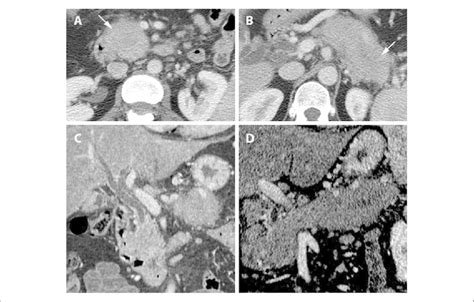 A 58 Year Old Female With Multifocal Autoimmune Pancreatitis The Download Scientific Diagram