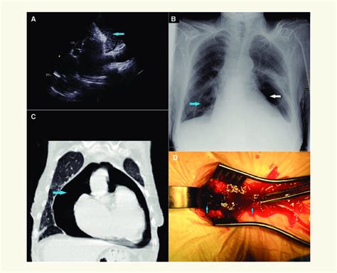 Panel A Transthoracic Echocardiographic Modified Apical Five Chamber