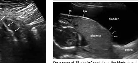 Diagnosing Placenta Accreta Spectrum With Prenatal Ultrasound