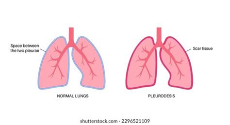 Pleurodesis Photos Images Pictures Shutterstock