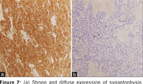 Figure 2 From Neuroendocrine Neoplasms In Rare Locations