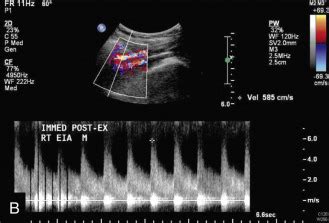 Lower Extremity Arterial Ultrasound Radiology