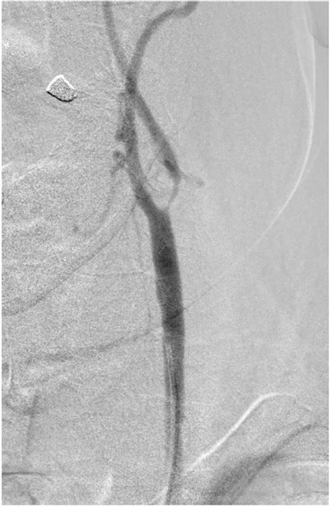 Dsa Showing Tight Left Internal Carotid Artery Stenosis Foot Note