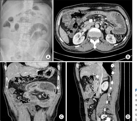 Pdf Robotic Assisted Resection Of Proximal Jejunal Ischemic Stricture