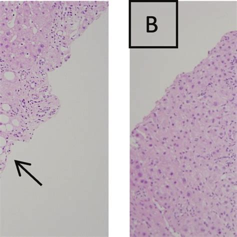 Microscopic Findings Of Pseudocirrhosis Through Hematoxylin And Eosin