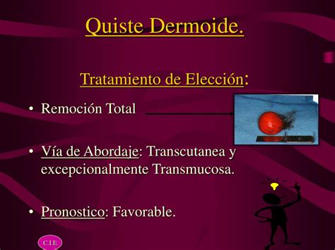 PPT Quistes Dermoides PowerPoint Presentation ID 425244