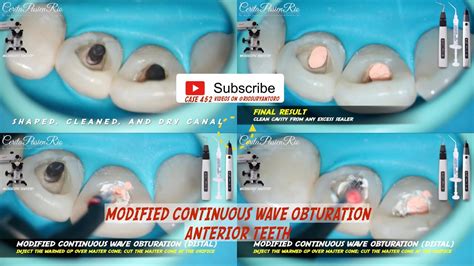 Modified Continuous Wave Obturation Anterior Teeth Fast Pack Fast Fill