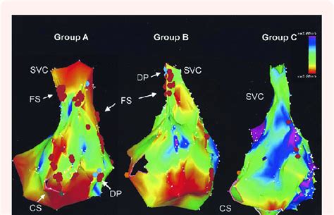 Electroanatomic Bipolar Voltage Mapping Color Annotation Is With