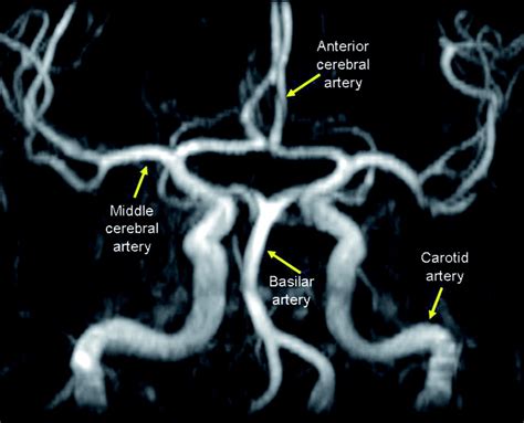 Circle Of Willis Angiogram Quiz