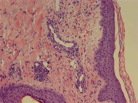 Skin Biopsy Revealing Perivascular And Neutrophilic Infiltrates And