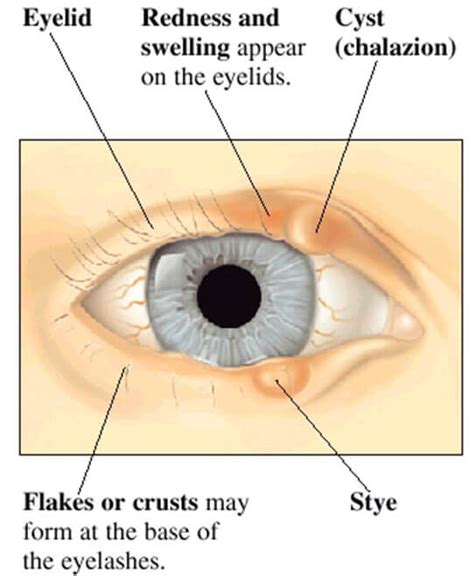 Eyelid Cyst