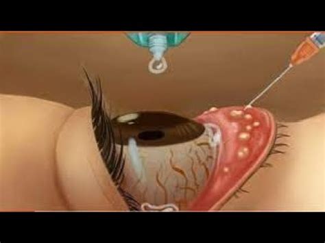 ASMR Very Satisfying on eye 침샘 결석 제거 애니메이션 Salivary Gland Stones