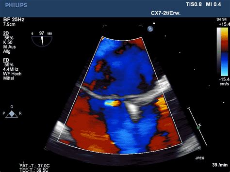 Pfo Color Doppler Universitätsklinik Für Intensivmedizin