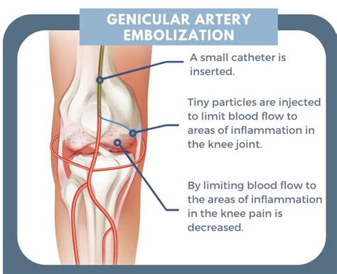 Genicular Artery Embolization Interventional Radiology