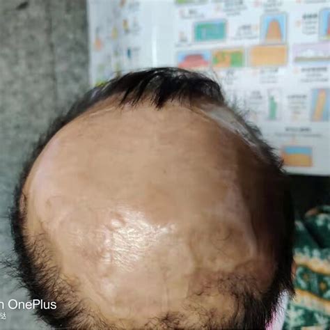 The Scalp Of The Patient With Aplasia Cutis Congenita At 2 Years Old