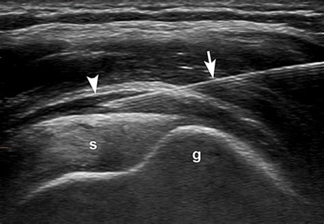 Subacromial Subdeltoid Bursa Injection Ultrasound Guided Image | The Best Porn Website