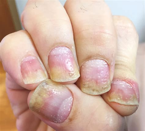 9 Types Of Psoriasis Pictures Symptoms Triggers Diagnosis And