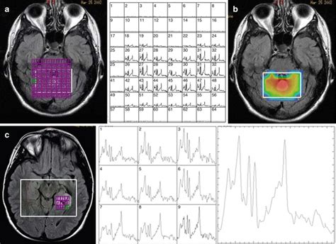Magnetic Resonance Spectroscopy | Radiology Key