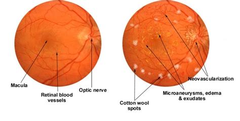 Diabetic Retinopathy Screening And Treatment — Downtown Eyecare And Optical