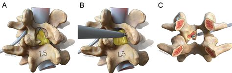 En Bloc Resection Of Ligamentum Flavum With Laminotomy Of The Caudal