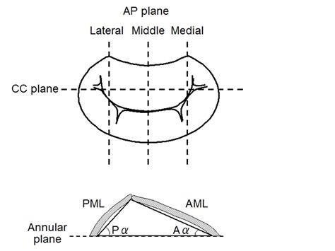 Abstract 19873 Relationship Between Jet Direction And Mitral Valve Tethering In Patients With