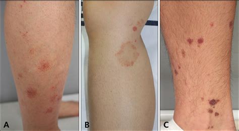 Figure 1 From Characteristics And Clinical Manifestations Of Pigmented