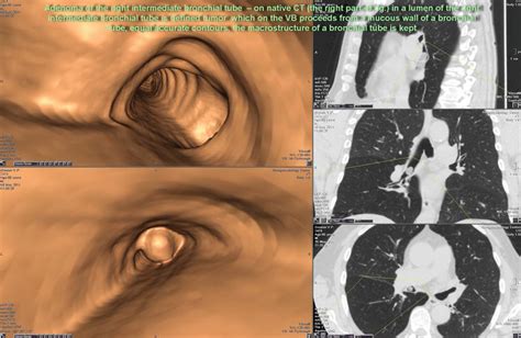 Virtual Bronchoscopy For Tumors And Traumatic Lesions Of The Airways