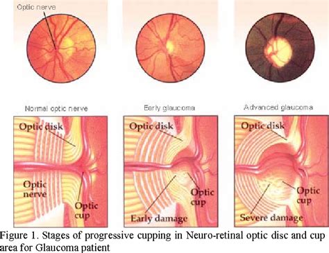 Photos Of Glaucoma Optic Nerve Cupping