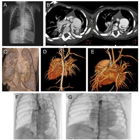 (A) Lung x-ray. (B) The exit of the pulmonary arteries from the... | Download Scientific Diagram