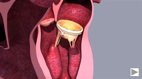 Animation Of The Saturn Tmvr System Trans Septal Procedure Innovheart