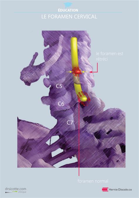 Sympt Mes St Nose Foraminale Cervicale Hot Sex Picture