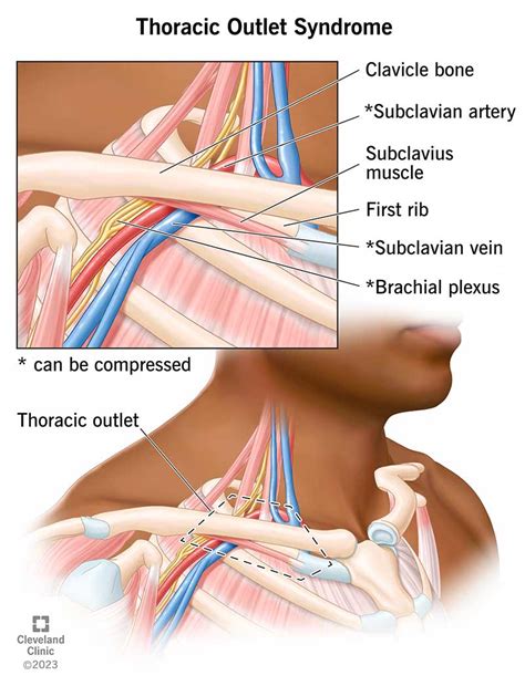 Thoracic Outlet Syndrome X Ray