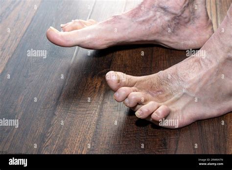 Mans Deformed Hammertoes Showing Left Foot One Year After Surgery