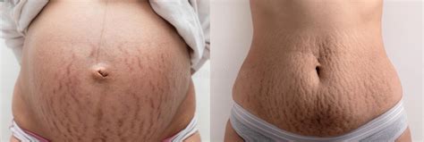 Stretch Marks After Pregnancy Stock Photo Image Of Scarred Body