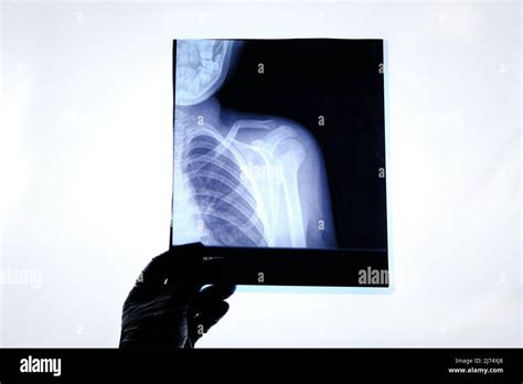 X-ray image of a man with a broken collarbone Stock Photo - Alamy