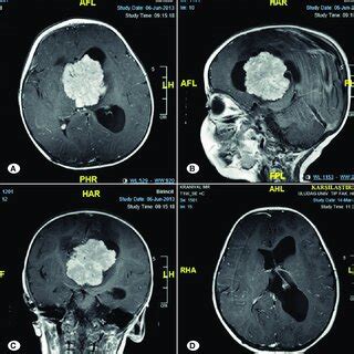 Preoperative Contrast Enhanced Mr Images A Axial B Sagittal C