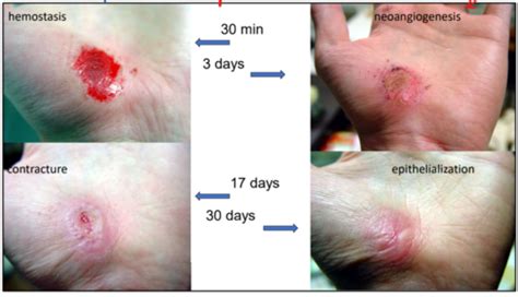 Path Wound Healing Flashcards Quizlet