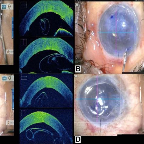 Descemet S Membrane Stripping Endothelial Keratoplasty Procedures A